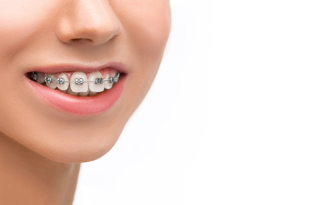 Prophylaxis for Orthodontic Patients: Keeping Your Braces Clean and Effective